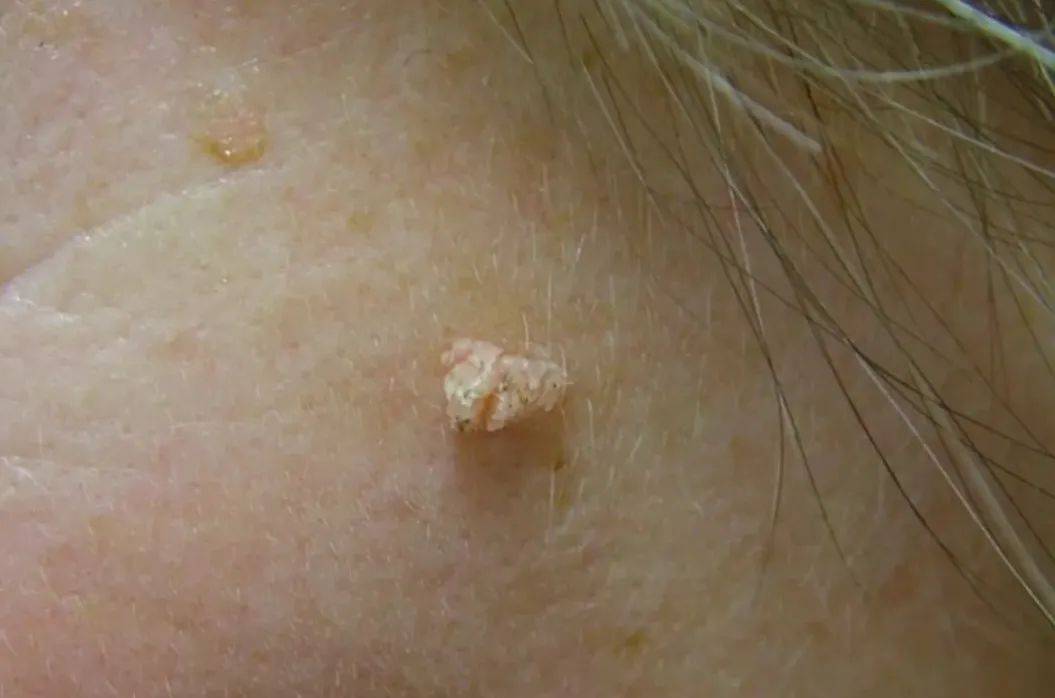 皇冠信用網在哪里开通
_脖子上长出的小肉粒皇冠信用網在哪里开通
,能揪吗?