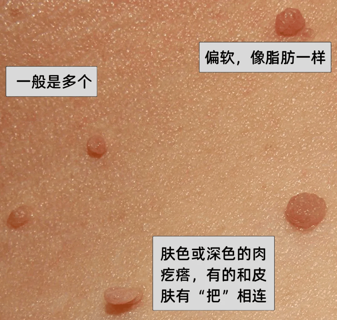 皇冠信用網在哪里开通
_脖子上长出的小肉粒皇冠信用網在哪里开通
,能揪吗?